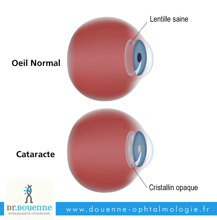 Cataracte traitement chirurgie de l'oeil